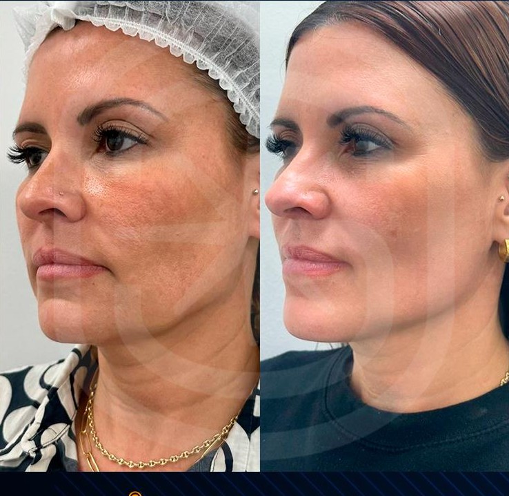 Antes y después de un caso real de Endoláser Facial en una paciente mujer