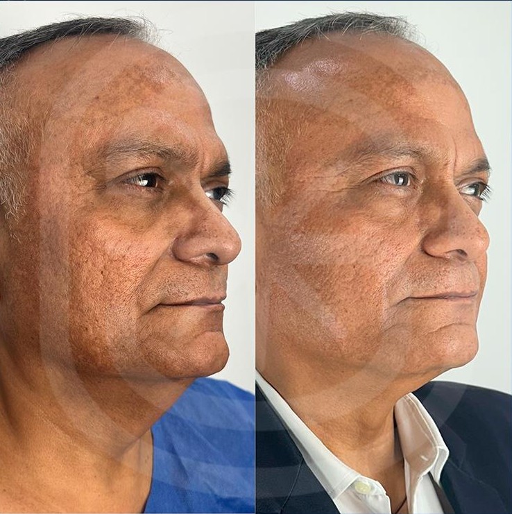 Antes y después de un caso real de Endoláser Facial en un paciente hombre